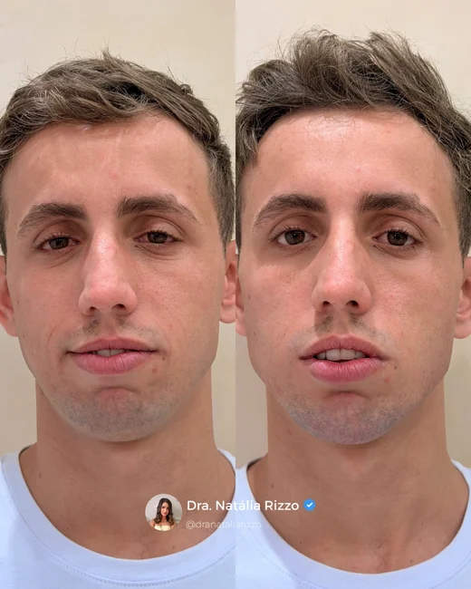 Harmonização Facial